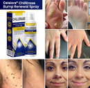 CHILLERASE CONGELDOR DE VERRUGAS
