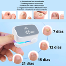 LASER PARA UNHAS DOS PÉS