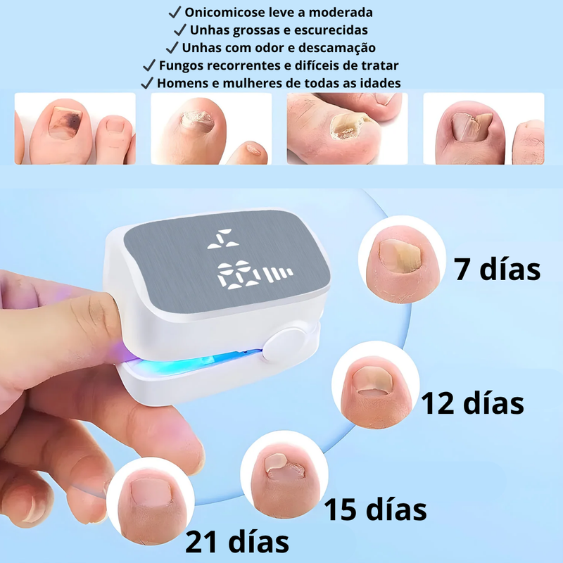 LASER PARA UNHAS DOS PÉS