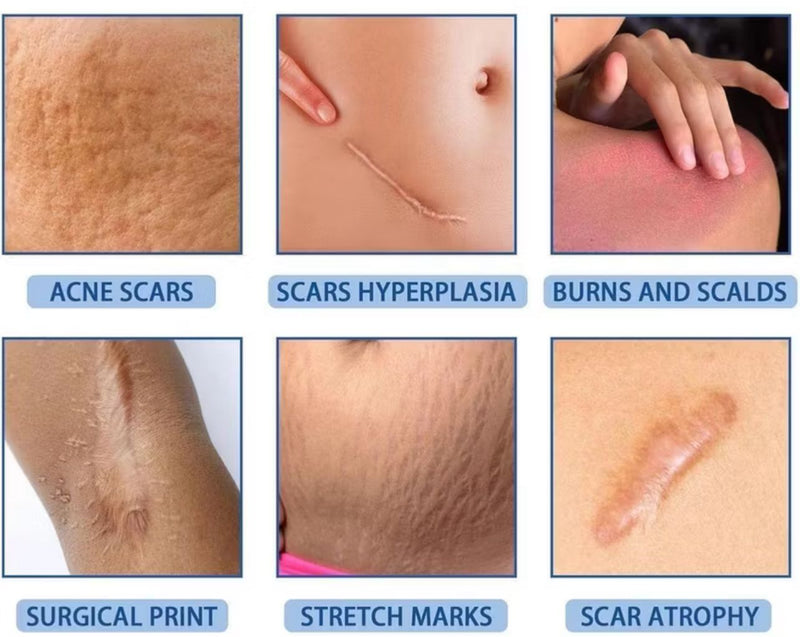 REMOVEDOR DE VERRUGAS E CICATRIZES CREME DR.VERRUGA