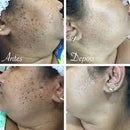 REMOVEDOR DE VERRUGAS E CICATRIZES CREME DR.VERRUGA