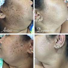 REMOVEDOR DE VERRUGAS E CICATRIZES CREME DR.VERRUGA