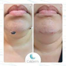 REMOVEDOR DE VERRUGAS E CICATRIZES CREME DR.VERRUGA