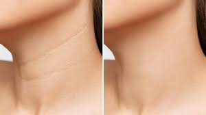 Creme antí-flacidez lifting instantâneo ROLON FIRMx®